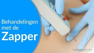 Fibromen en ouderdomswratjes verwijderen met de Zapper [upl. by O'Malley]