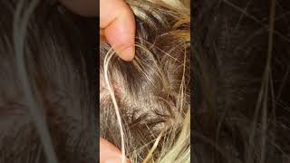 1 good scalp scab picking scratching with fingernails dandruff on my sister ASMR hair little talking [upl. by Adoc787]