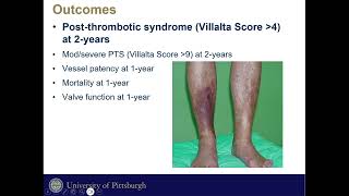 Post Thrombotic Syndrome Morbidity In Mechanical Thrombectomy Vs CDT of Iliofemoral DVT [upl. by Ardnasela254]