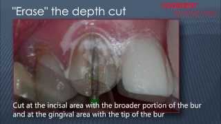 Composite Veneers Preparation [upl. by Norrag]