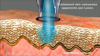 Le traitement de la couperose au laser  Dr Barry [upl. by Eradis]