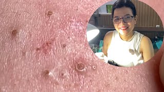 Acne Treatment Huong Da Nang573  2023 [upl. by Bowles305]