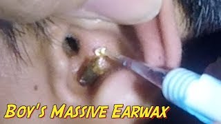 Boys Massive Earwax Removal from Both Ears [upl. by Naihtniroc]