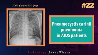 Pneumocystis carinii Pneumonia  Radiology  1000 videos in 100 days  Radiology Everywhere [upl. by Alahc]