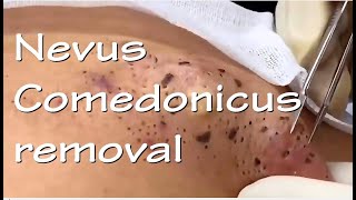 Nevus Comedonicus removal  Video 3 of 3 The ultimate quotblackheadquot removal video [upl. by Zandra808]