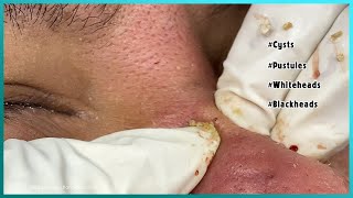 Big Cystic Acne Blackheads Extraction Blackheads amp Milia Whiteheads Removal Pimple Popping [upl. by Inaniel]