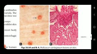 Apurba S Sastry Microbiology Viral Exanthems amp other parvovirus infections part 2 measles amp rubella [upl. by Katharyn]