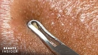 How Lip Blackheads Are Extracted  Beauty Insider [upl. by Enorej]