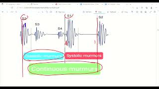 Heart murmurs Part2  Heart murmur sounds  Cardiovascular system  Lec 16 [upl. by Poirer]