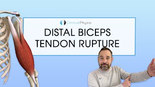 Distal Biceps Tendon Rupture  Expert Physio Review [upl. by Aryahay]