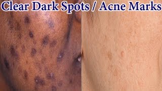 Home Remedy To Get Rid Of Dark Spots Acne Marks Naturally Fast [upl. by Slavic984]