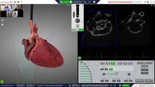 TEE Transeptal Online Training [upl. by Sergent115]