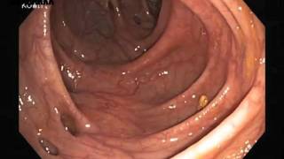 Diverticulosis lesion from Colonoscopy [upl. by Ettelocin]