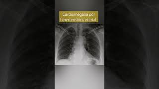 CARDIOMEGALIA POR HIPERTENSIÓN PIQUETES Y PUNZADAS EN EL PECHO FALTA DE AIRE [upl. by Ahsik]