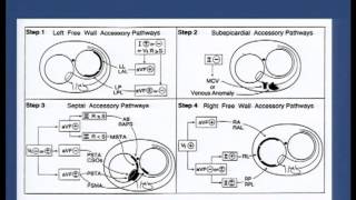 Pre  excitation syndromes  Dr Shashidhar 29092013 18 [upl. by Atteloc]