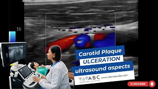 CAROTID PLAQUE ULCERATION ULTRASOUND ASPECTS [upl. by Orva]