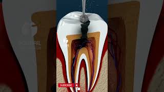 Root Canal Treatment [upl. by Nytsirc291]