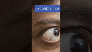 Exophthalmos imwell Exophthalmos [upl. by Alejandra]