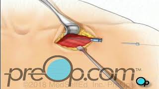 Permanent Pacemaker Implant Surgery  PreOp® Patient Education [upl. by Aztilay]