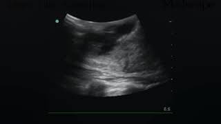 Breast Abscesses and Masses  Medical Review [upl. by Llehsem]