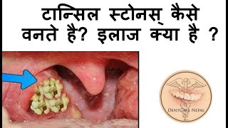 Tonsil Stones  Tonsilloliths Causes and Treatment  IN HINDI [upl. by Nylsoj615]