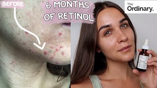 RETINOL CLEARED MY ACNE  BEFORE amp AFTER  6 months update  THE ORDINARY [upl. by Areivax]