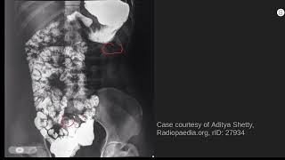 Midgut malrotation radiology abr core [upl. by Eyllek]