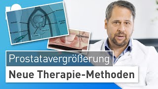 Prostatavergrößerung Neue Verfahren zur operativen Behandlung der BPH [upl. by Chabot]