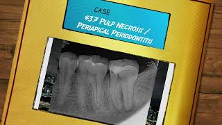 ProTaper Ultimate case 37 visit1 access pulpectomy WLM shaping Calciumhydroxide [upl. by Lered]