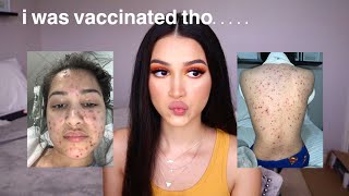 i got the chicken pox at 22 years old  storytime with pictures [upl. by Scoter]