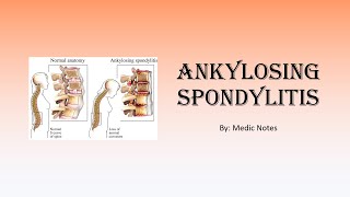 Ankylosing spondylitis  signs and symptoms Schober test Faber test imaging treatment [upl. by Teressa]