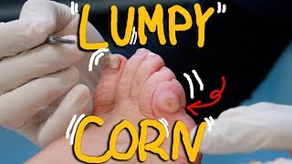 Satisfying Corn Removal with Callus HUGE LUMPY Corn [upl. by Lewse709]