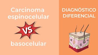 Diagnóstico Diferencial Carcinoma espinocelular vs basocelular [upl. by Eiclehc416]