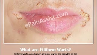 Filiform Warts Causes Symptoms and Treatment [upl. by Andromeda]