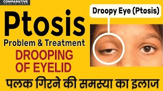 Ptosis  पलक गिरने की समस्या का इलाज  Dr Pasricha Eye amp Dental Hospital  karnal [upl. by Onstad623]