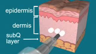 Radiesse Injection Technique Animation [upl. by Astred430]