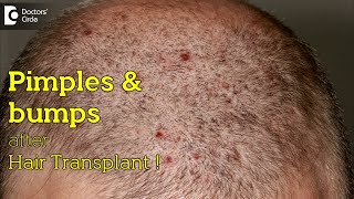 Pimples and bumps on transplanted hair and donor area after hair transplant  Dr Deepak P Devakar [upl. by Annamaria]