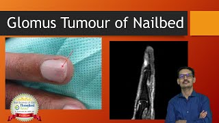 Glomus Tumor English Nailbed [upl. by Rambow]