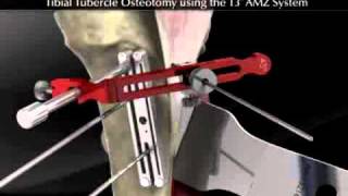 Tibial Tubercle Osteotomy using the T3 AMZ System [upl. by Etsirhc421]