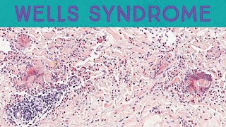 Wells syndrome eosinophilic cellulitis with flame figures pathology dermatology dermpath [upl. by Remlap]