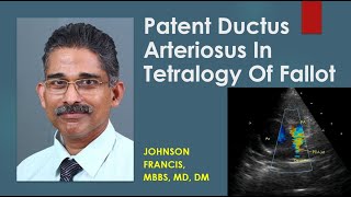 Patent Ductus Arteriosus In Tetralogy Of Fallot [upl. by Etselec]