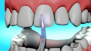 Dental Bonding Video  Tooth Bonding [upl. by Dnalevets]