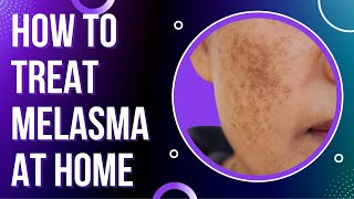 How to treat MELASMA at Home  Treat DARK SPOTS amp PATCHES on the skin [upl. by Eseyt]