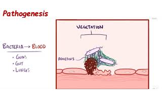 infective endocarditis in pediatrics Dr mohamed abdelghafar 29032020 [upl. by Ttemme]