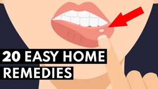 How To Get Rid Of Canker Sores FAST [upl. by Knuth620]