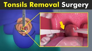 How Tonsillectomy is Performed  Tonsils Removal Surgery [upl. by Odarbil]