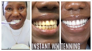 How I whitened my yellow teeth in 2 Minutes  LIVE DEMO HOME REMEDY [upl. by Hahsi]