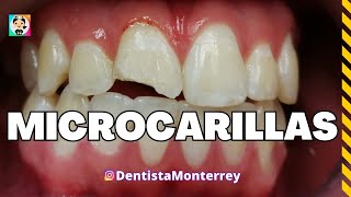 MICROCARILLA DENTAL de Porcelana👅microcarillas carillasdeporcelana [upl. by Dennie288]