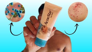 Acnestar face wash review  kya acnestar soap se behtar hai [upl. by Elem]