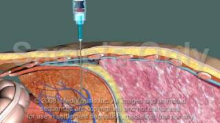 Thoracotomy  Improper Procedure [upl. by Neik]